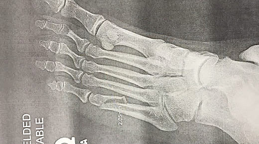 Axl Rose broke his foot, but Vegas shows happening