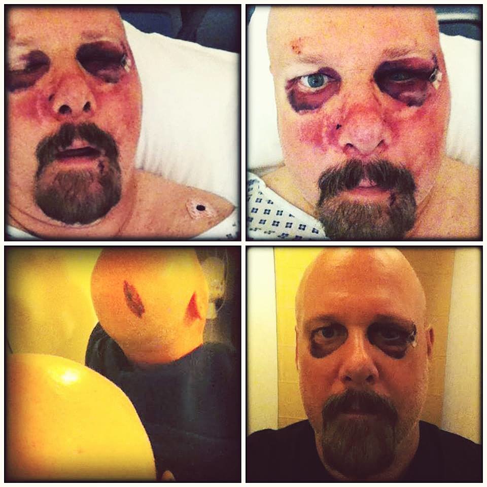 Pro-Pain’s Gary Meskill posts photos & statement on injuries from horrific attack
